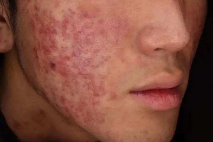 美容外科 美容皮膚科 藍住 たまき青空クリニック 徳島で脱毛 ハイフ シミ そばかす 肝斑 ほくろ ボトックス ヒアルロン酸 二重の治療