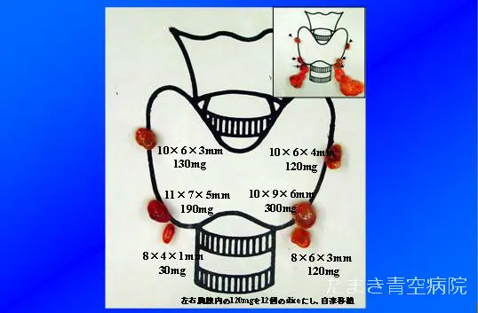二次性副甲状腺機能亢進症について｜乳腺・甲状腺外科外来｜たまき青空 