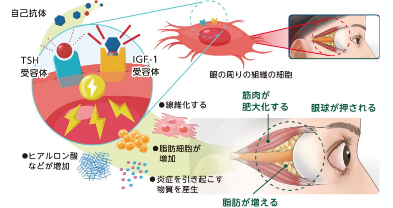 甲状腺眼症（バセドウ眼症）のテッペーザによる治療 | たまき青空病院