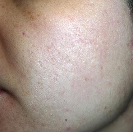 ニードルRF Matrix Pro 5回治療から1ヶ月後