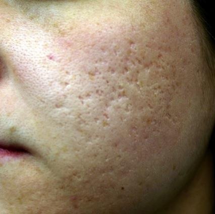 ニードルRF Matrix Pro 治療前