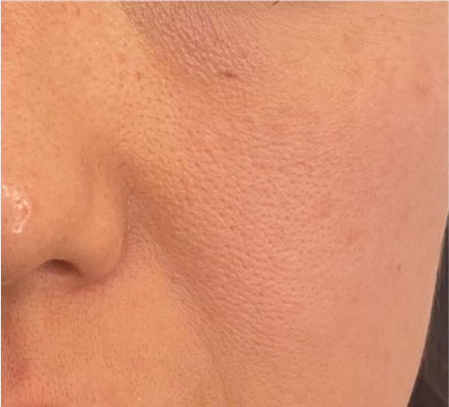 バイポーラーRF Sublime 治療前